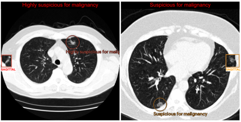 Computer-aided diagnosis for lung cancer screening